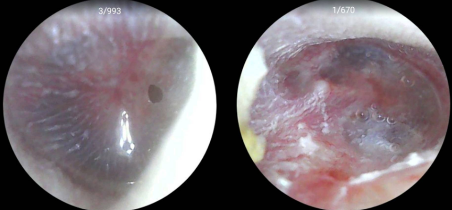 Digital otoscope examination